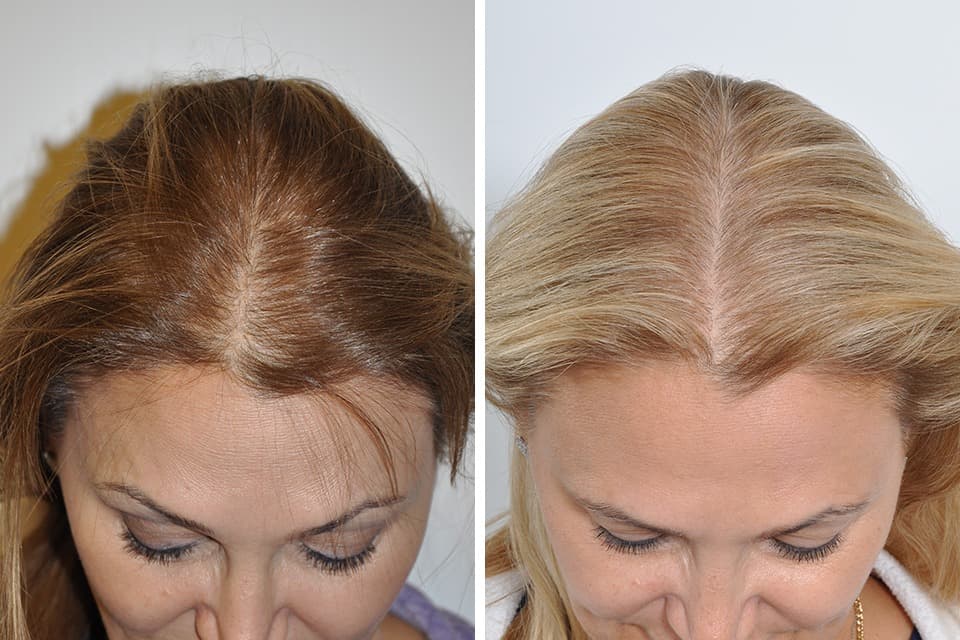 Hair Transplant Turkey Treatment by Sapphire Hair Clinic