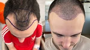 Affordable Hair Transplant London – Natural Results You’ll Love